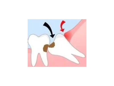 吃完飯后老塞牙？別大意！這可能是你的牙齒在報警