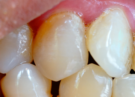 牙齒表面的牙釉質(zhì)掉了還可以修復(fù)嗎？