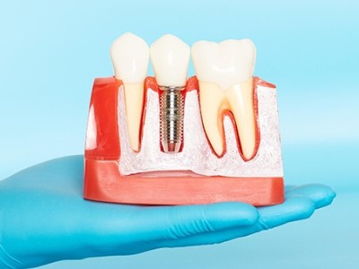 種牙VS鑲牙，你適合哪種?