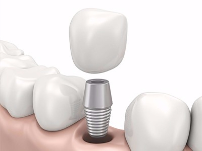 在承德哪家口腔醫(yī)院口腔種植齒好一點，惟德口腔醫(yī)院值得您的選擇