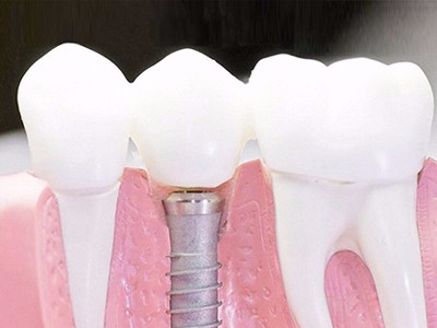 在承德口腔種植齒需要多少錢？惟德口腔一一為您道來